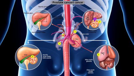 can prostate cancer spread